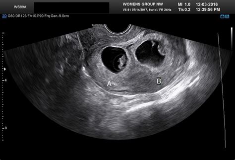 13 mm per day. . Empty gestational sac at 10 weeks success stories